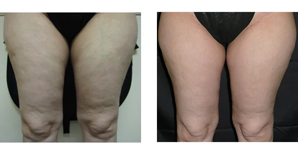 Before and After Acne Scarring Treatment