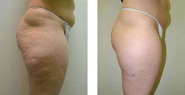 Before and After Acne Scarring Treatment