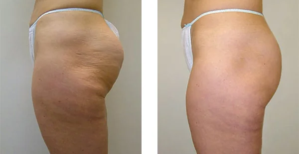 Before and After Acne Scarring Treatment