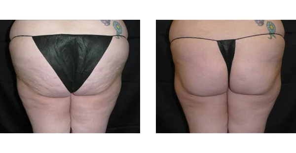Before and After Acne Scarring Treatment