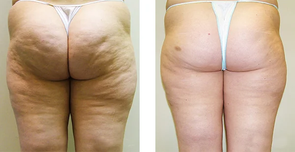 Before and After Acne Scarring Treatment