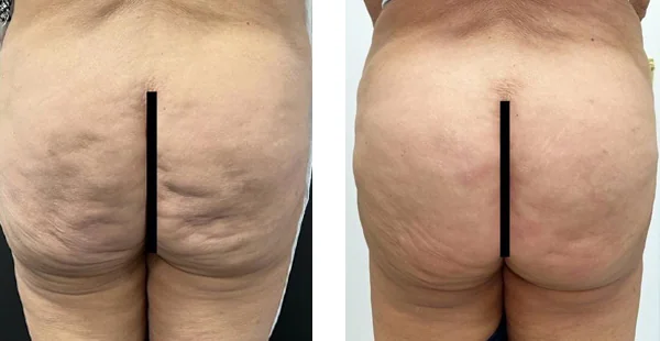 Before and After Acne Scarring Treatment
