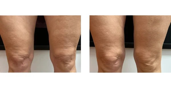 Before and After Acne Scarring Treatment