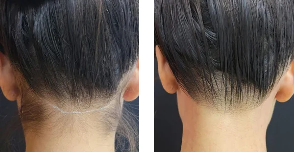 before-after-by-khrom-med-spa-in-Brooklyn-NY