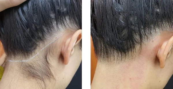 before-after-by-khrom-med-spa-in-Brooklyn-NY