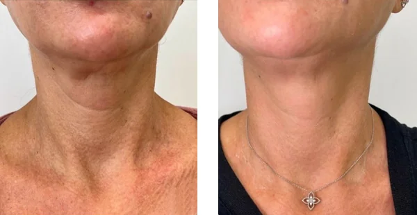 before-after-by-khrom-med-spa-in-Brooklyn-NY