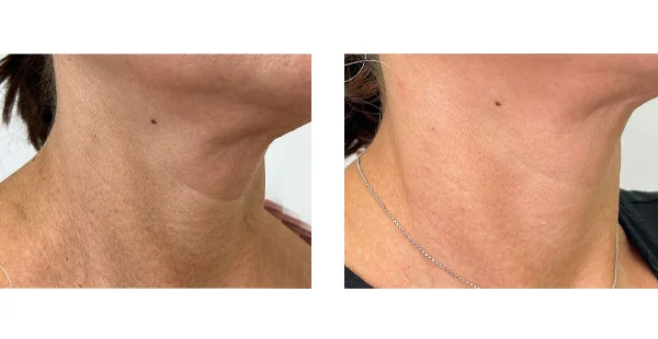 before-after-by-khrom-med-spa-in-Brooklyn-NY